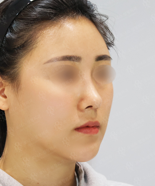 낮은코+비주교정+이마지방이식 수술 한달 후 45도