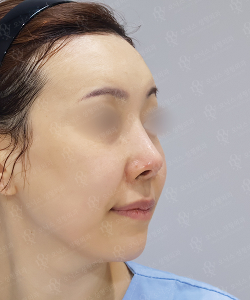 자가늑 코재수술[휜코+짧은코+비주교정] 수술 전 45도