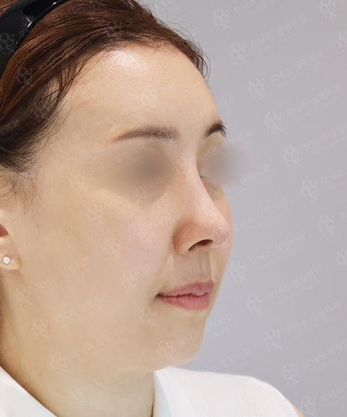 자가늑 코재수술[휜코+짧은코+비주교정] 수술 한달 후 45도