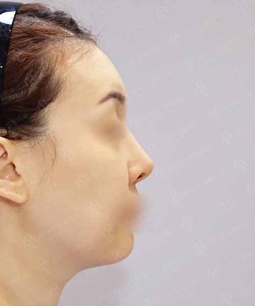 자가늑 코재수술[휜코+짧은코+비주교정] 수술 전 측면