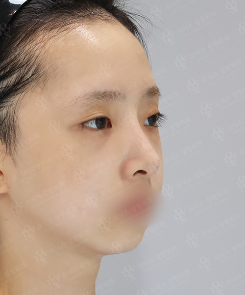 자가늑 코재수술[긴코+비주교정]+쌍꺼풀재수술+눈위지방이식 수술 전 45도