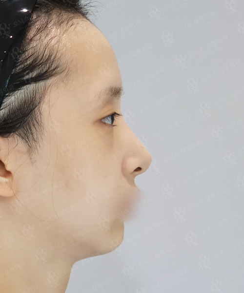 자가늑 코재수술[긴코+비주교정]+쌍꺼풀재수술+눈위지방이식 수술 전 측면