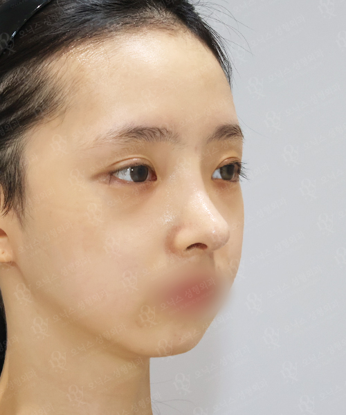자가늑 코재수술[긴코+비주교정]+쌍꺼풀재수술+눈위지방이식 수술 한달 후 45도