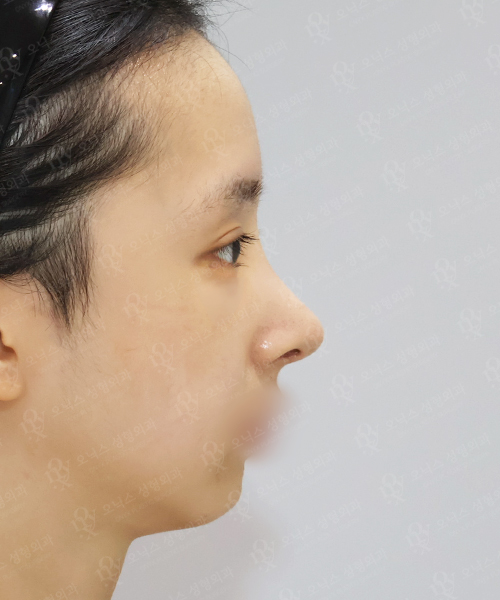 자가늑 코재수술[긴코+비주교정]+쌍꺼풀재수술+눈위지방이식 수술 한달 후 측면