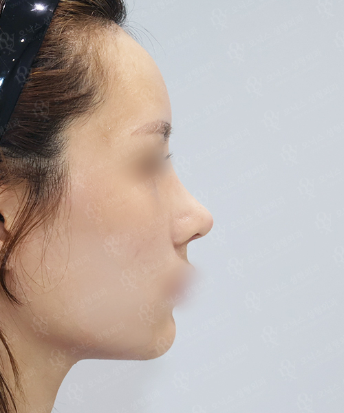 복코+절골 수술 한달 후 측면