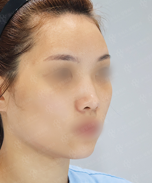 복코+절골 수술 전 45도