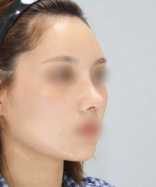복코+절골 수술 한달 후 45도