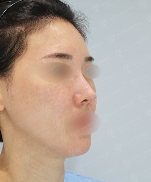 코재수술 [콧대+코끝(알로덤)] 수술 전 45도