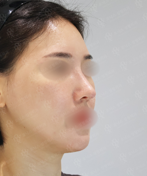 코재수술 [콧대+코끝(알로덤)] 수술 한달 후 45도
