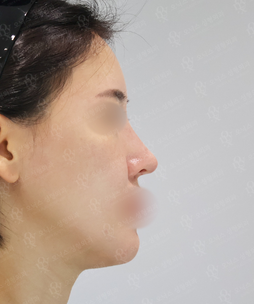 코재수술 [콧대+코끝(알로덤)] 수술 한달 후 측면
