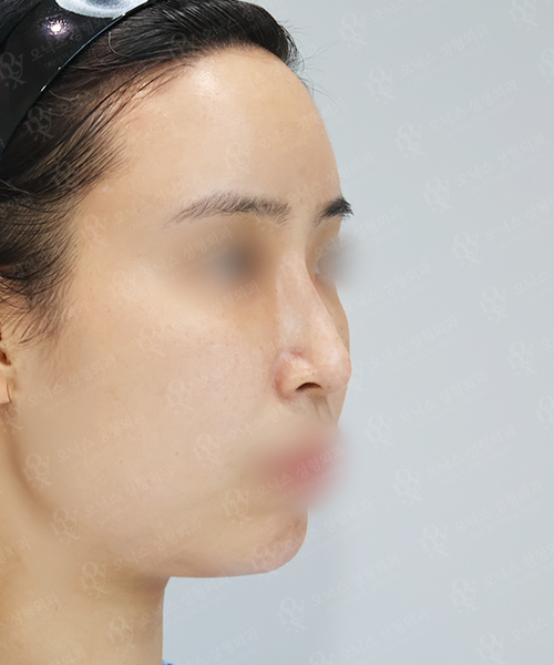 자가늑 코재수술[긴코+휜코+비주교정] 수술 전 45도