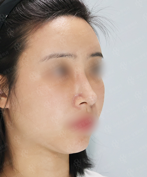 자가늑 코재수술[긴코+휜코+비주교정] 수술 한달 후 45도