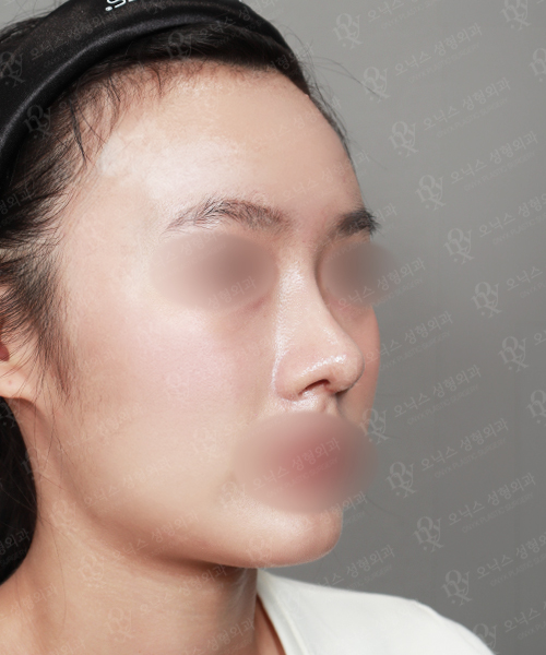 복코+낮은코교정 수술 한달 후 45도