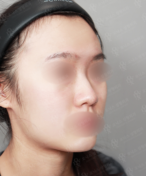 복코+낮은코교정 수술 전 45도
