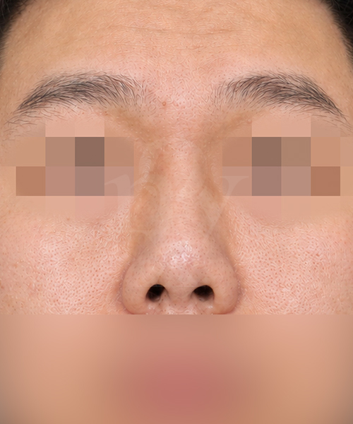 구축코 재수술 수술 한달 후 정면