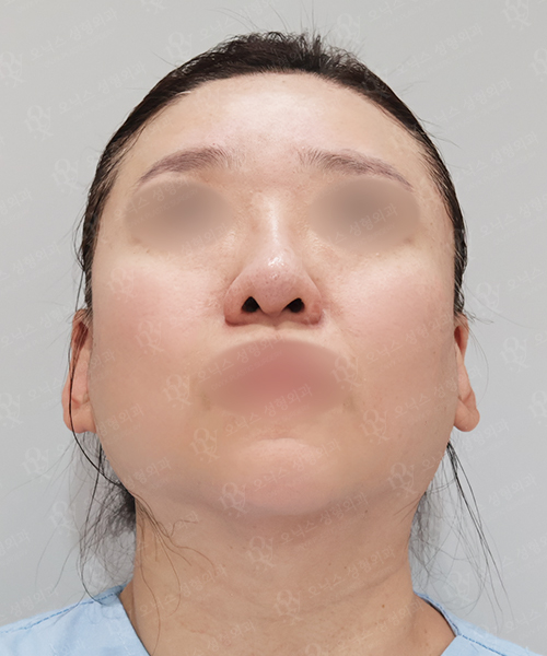 [코재수술] 복코+비주교정+비순각교정 수술 전 45도